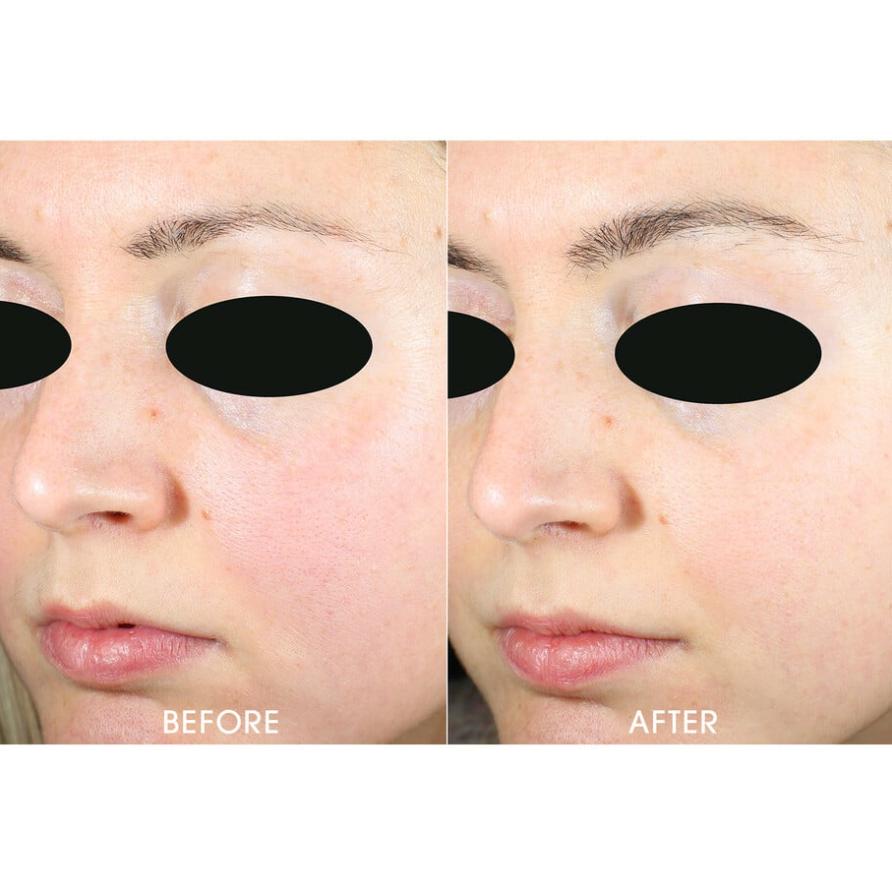 Active Microscrub | Teoxane